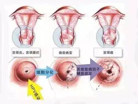 杂菌与HPV，深入了解与正确认知指南