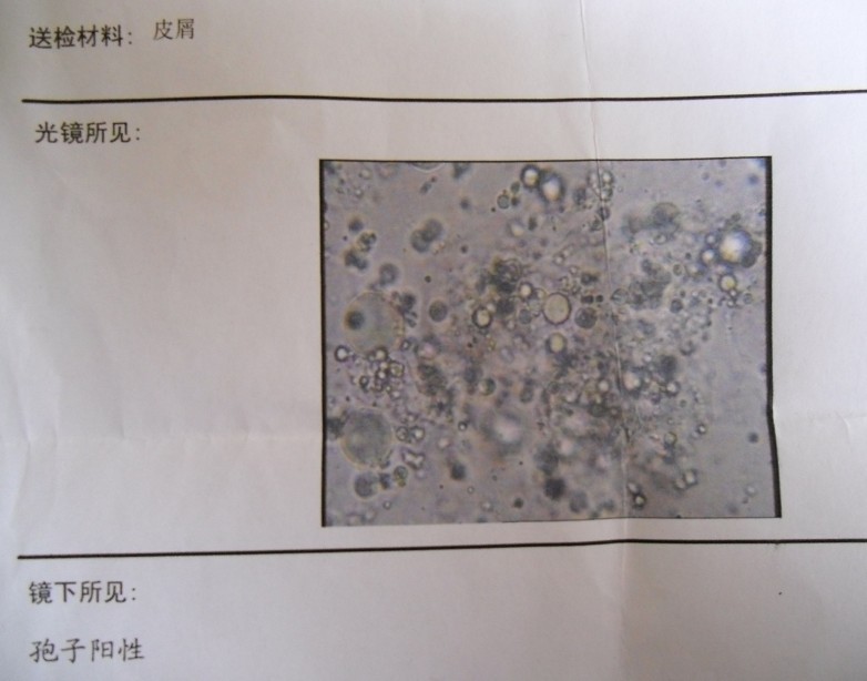 皮肤孢子检查发现，应对方法与深入了解指南