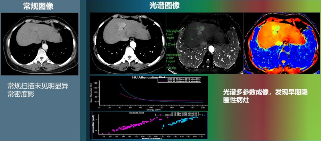 光谱CT与双源CT的差异及应用前景展望