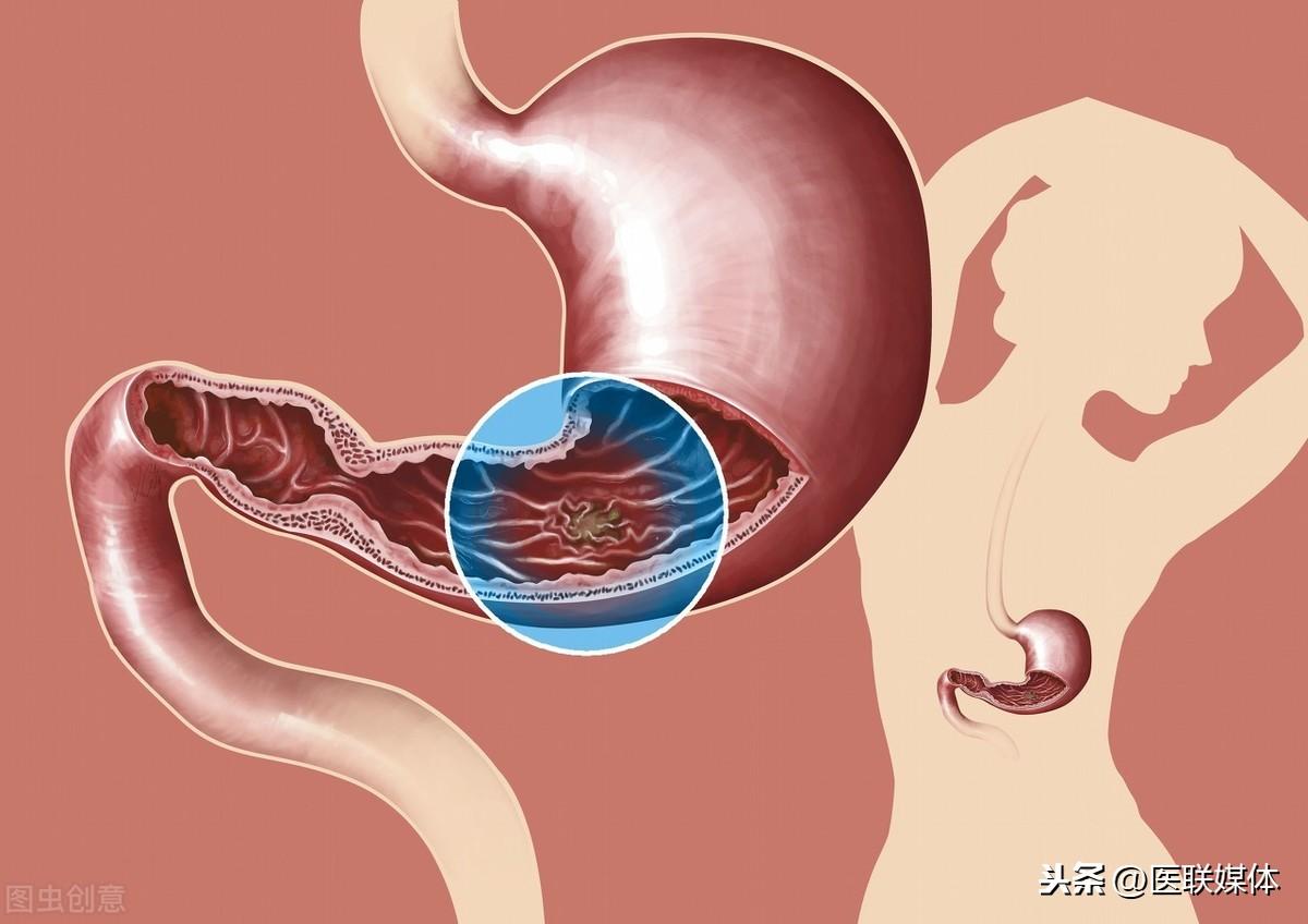 胃病患者出现五种症状需警惕