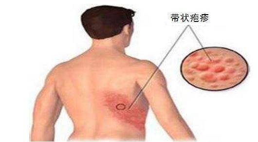 疱疹治疗用药指南，选择正确药物，了解疱疹接种性疱疹治疗法